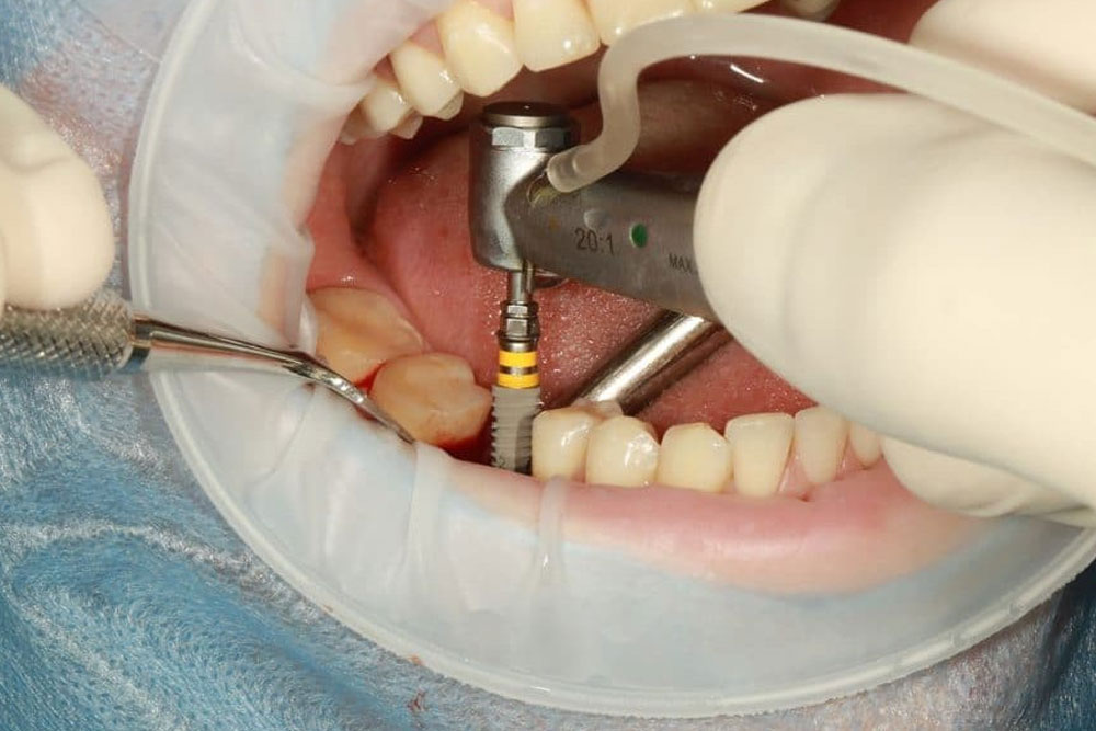 Dental Implants