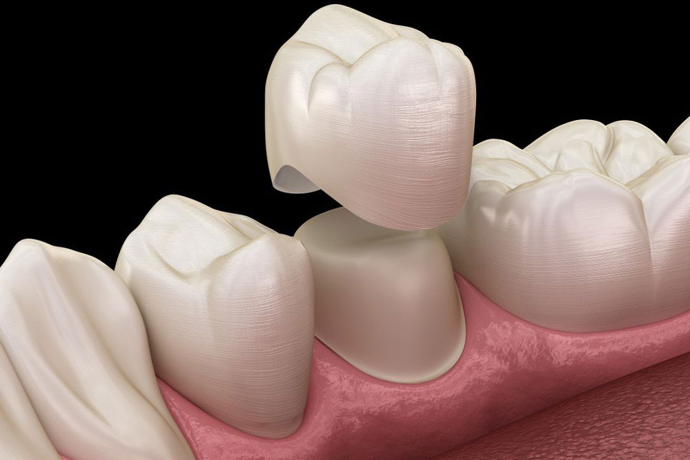 Dental Crowns & Bridges