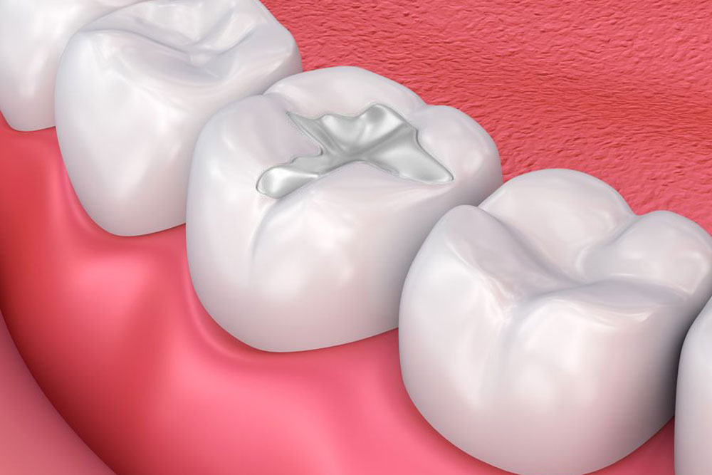 Dental Fillings