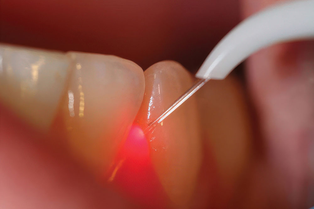 Laser Dentistry