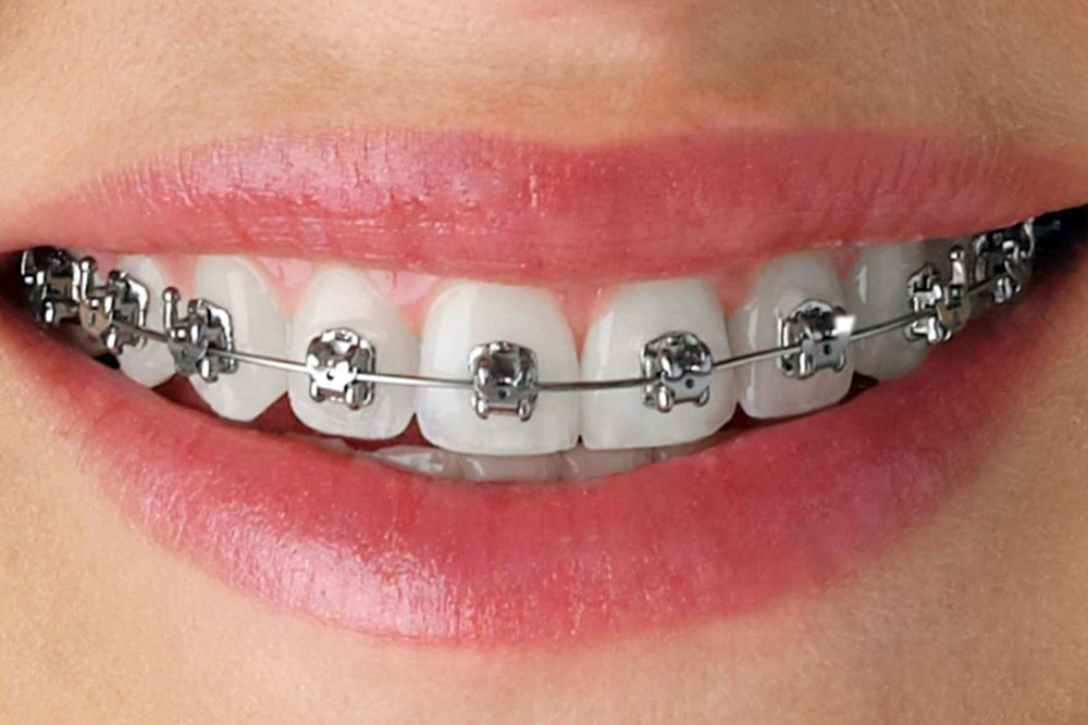 Orthodontic Treatment